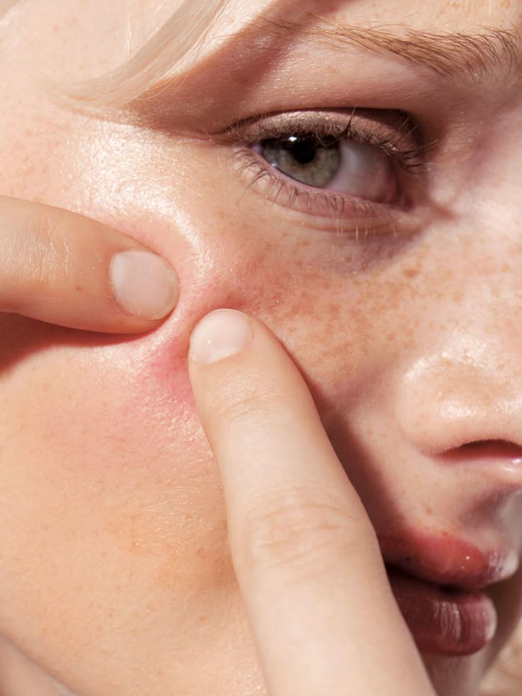 What's Actually Causing Your Acne (And What Helps)